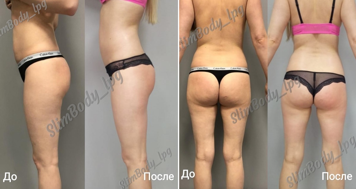 результаты лпг массажа