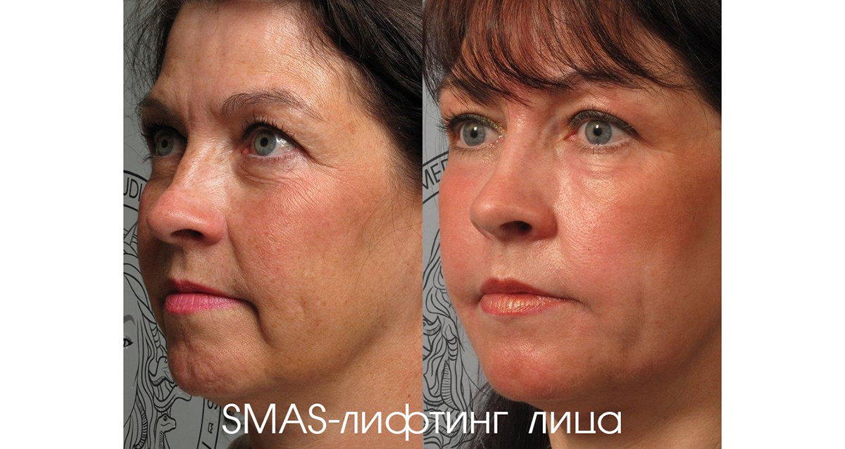 SMAS-лифтинг